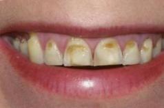 Что такое эрозия эмали зубов и как ее побороть?